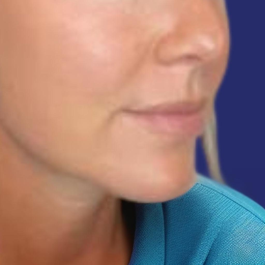 Foto's van kinvergroting met fillers: voor-en-na-resultaten in een kliniek in België