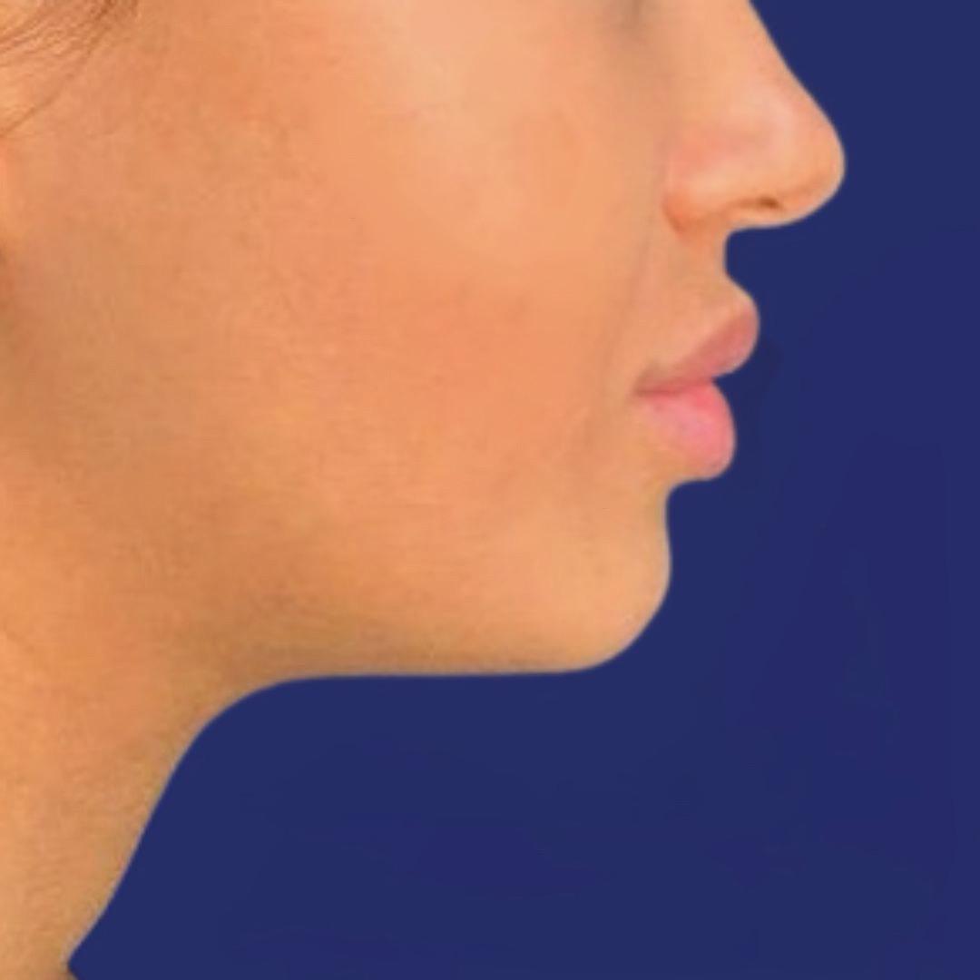 Vergelijking van voor-en-na-resultaten van gezichtscontouren met dermale fillers