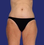 verwijder zadeltasjes liposuctie