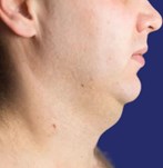 Neklift + liposuctie voor