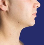 Neklift + liposuctie na