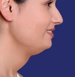 Foto van de liposuctie van de dubbele kin voor