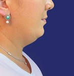 Verwijder dubbele kin met liposuctie