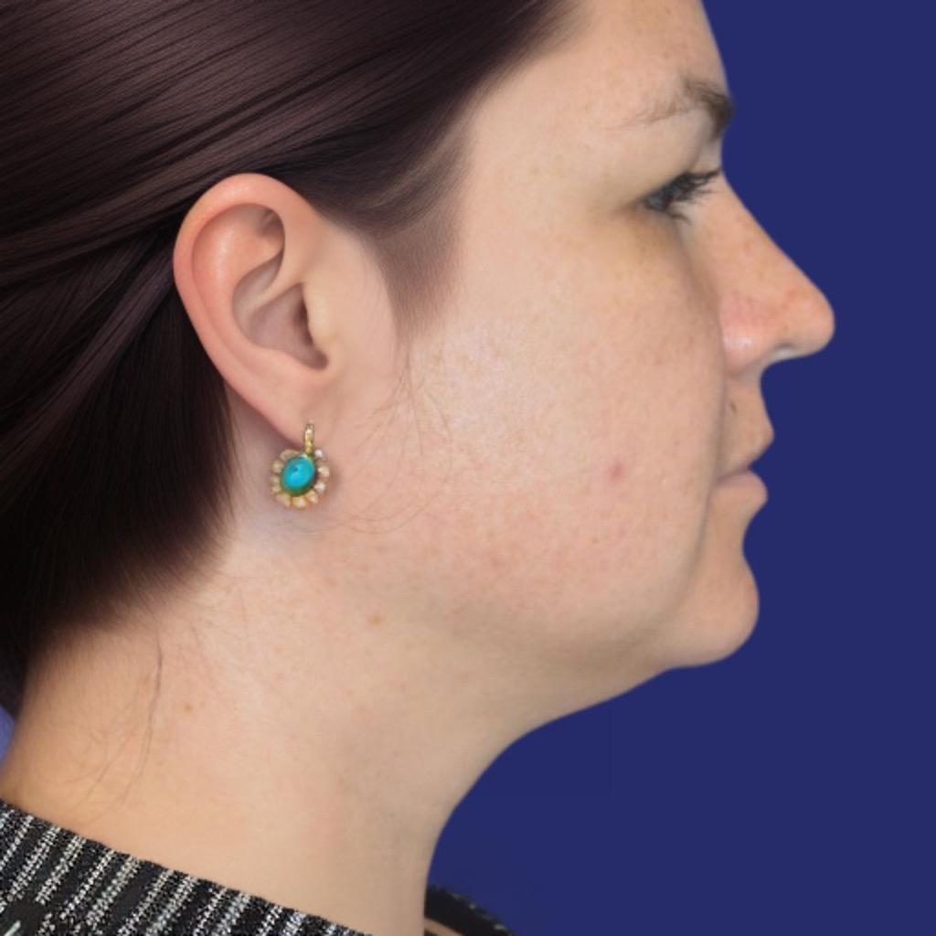 Natuurlijke lipo voor de dubbele kin