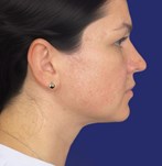 Natuurlijke resultaten van de lipo voor de dubbele kin