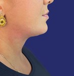 Foto van resultaten van echte patiënten die een dubbele kinverwijdering hebben ondergaan