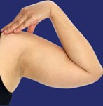 Voor liposuctie van de armen