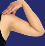Vergelijking van de armen voor en na liposuctie