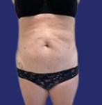Foto na liposuctie + abdominoplastie