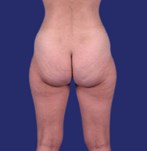 foto’s van liposuctie zadeltasjes