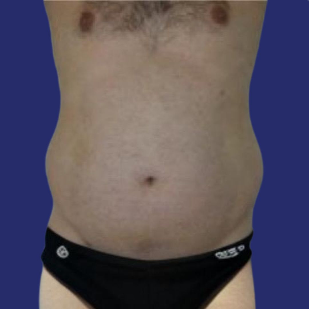 Foto’s tummy tuck man