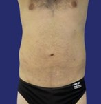 Patiënt met platte en strakke buik na Abdominoplastie