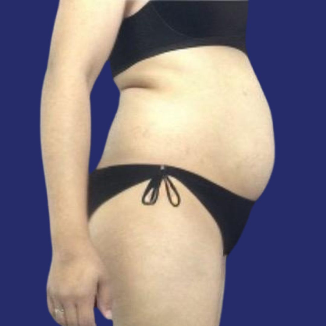 Buik voor Abdominoplastie  