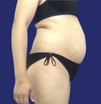 Buik voor Abdominoplastie