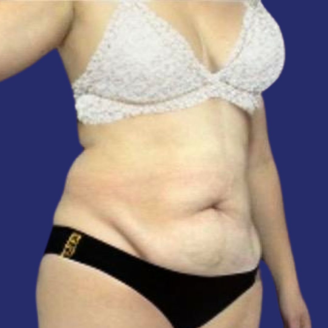 Patiënt met corrigerende Abdominoplastie voor hangende huid - Fleur-de-Lis buikwandcorrectie