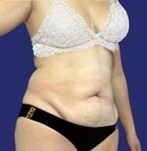 Patiënt met corrigerende Abdominoplastie voor hangende huid - Fleur-de-Lis buikwandcorrectie