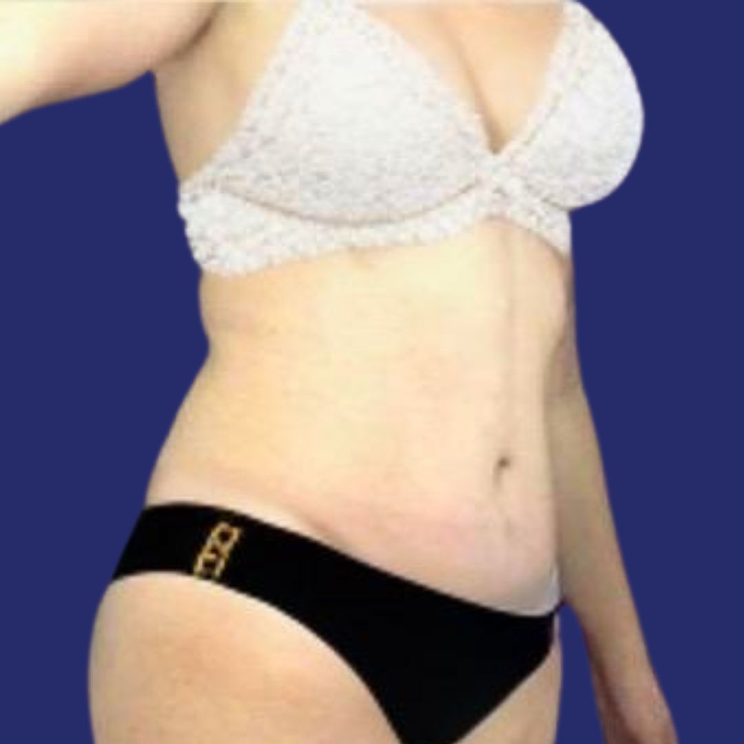 Patiënt met gecorrigeerde buik na plastische chirurgie herwint stevigheid in de buik