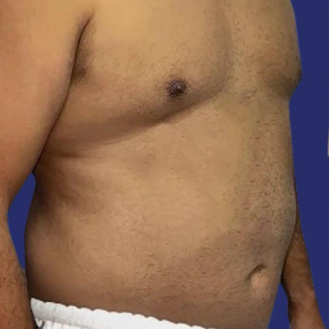 Mannelijke patiënt vóór buikwandcorrectie