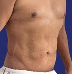 Mannelijke patiënt met herstelde buikspieren na Abdominoplastie