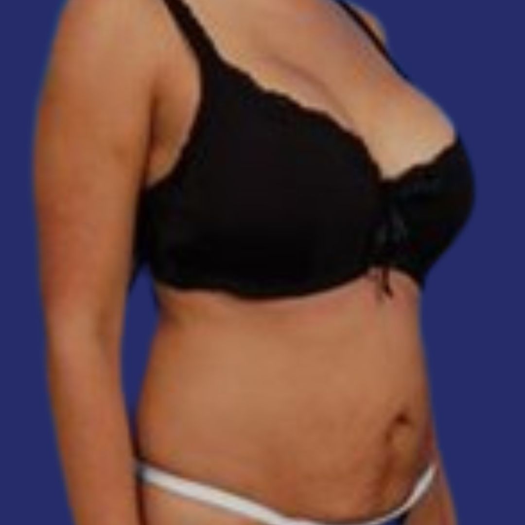  (Mini) buikwandcorrectie foto's