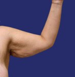 Patiënt met significante armflab voorafgaand aan een armliftprocedure