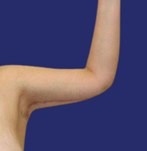 Gedefinieerde bovenarmen met verbeterde contour na brachioplastiek