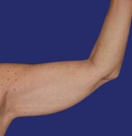 Zijaanzicht van hangende armhuid voor een armliftoperatie.