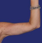 Zijaanzicht met stevige en gedefinieerde armen na een armlift