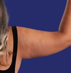 Patiënt met overtollig vet en huid aan de armen voor een armliftoperatie.