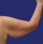 Arm met losse huid en verminderde tonus voor brachioplastiek