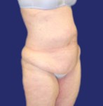 Voor dijlift gecombineerd met abdominoplastiek: laterale aanzicht toont slapheid in het dijgebied en een gebrek aan gedefinieerde lichaamscontour.