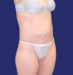 Na dijlift gecombineerd met abdominoplastiek: laterale aanzicht onthult verbeterde stevigheid en verwijdering van slappe huid in het dijgebied.