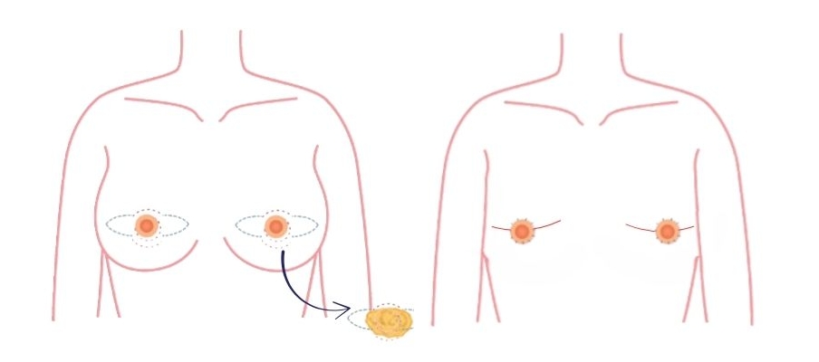 Batwing-procedure (fishmouth-incisie): voor een stevige borstkas en matige borstvorming
