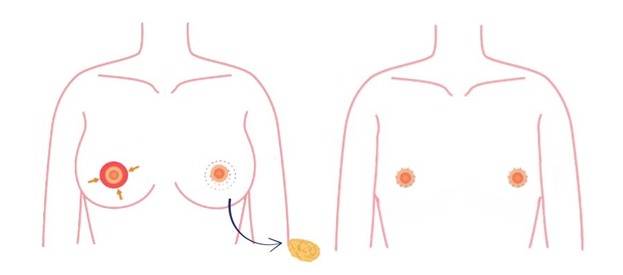 donut Peri-areolaire techniek: een subtiele borstkasmastectomie met minimale littekens