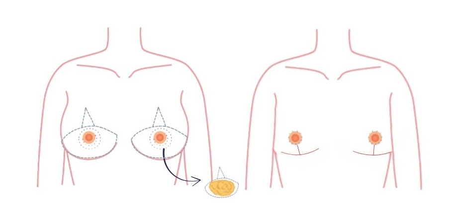 Omgekeerde T-techniek voor zwaardere of dikke borsten