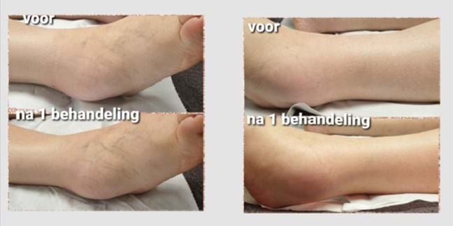 Lymfedrainage voor en na