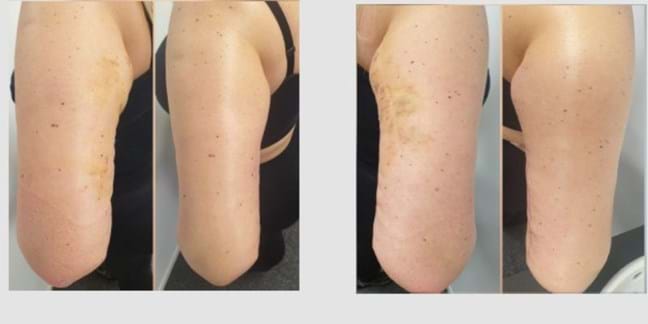 Post-liposuctie massages voor en na