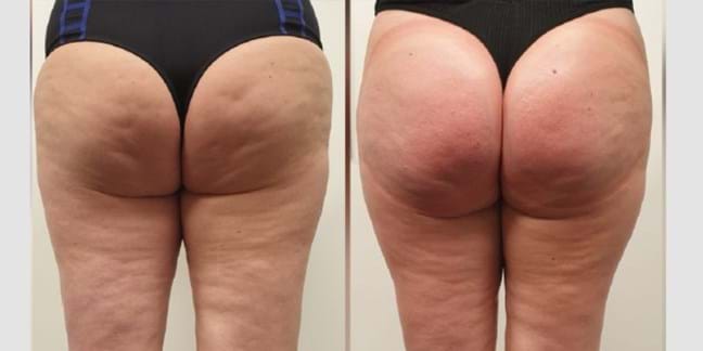 voor en na Natuurlijke bil lift – Cupping & vacuüm therapie