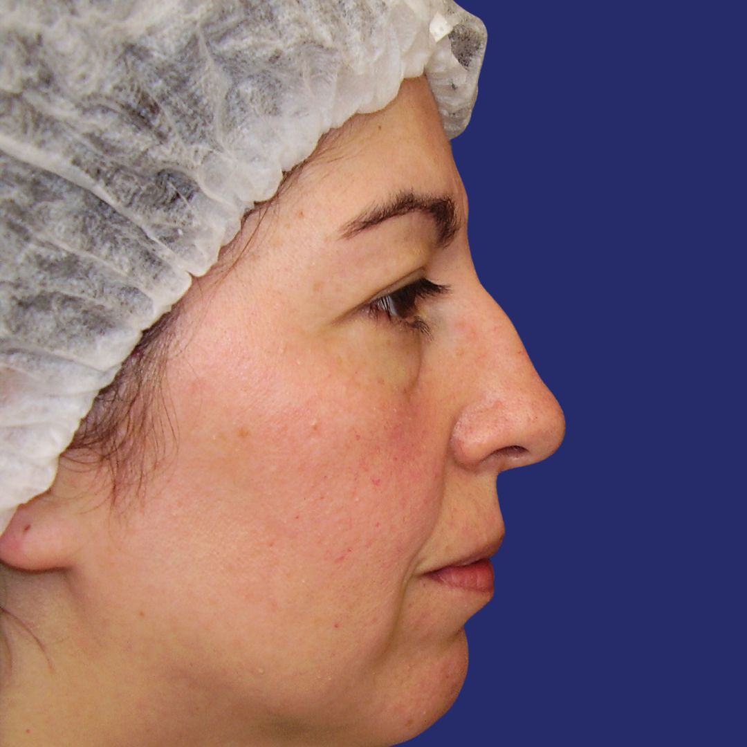Afbeelding vóór neuscorrectie met scheef neustussenschot en brede neus