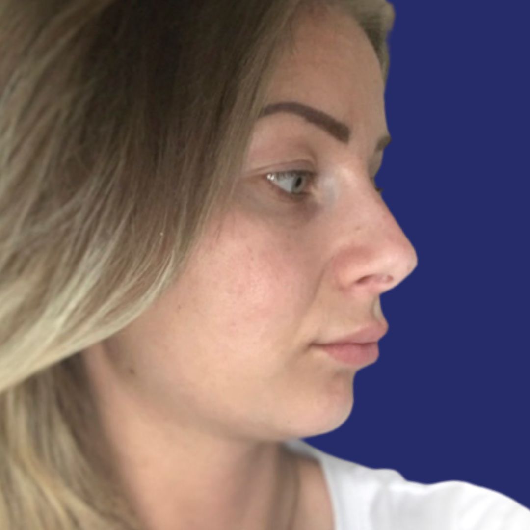 Gezicht vóór esthetische neuscorrectie in Genk