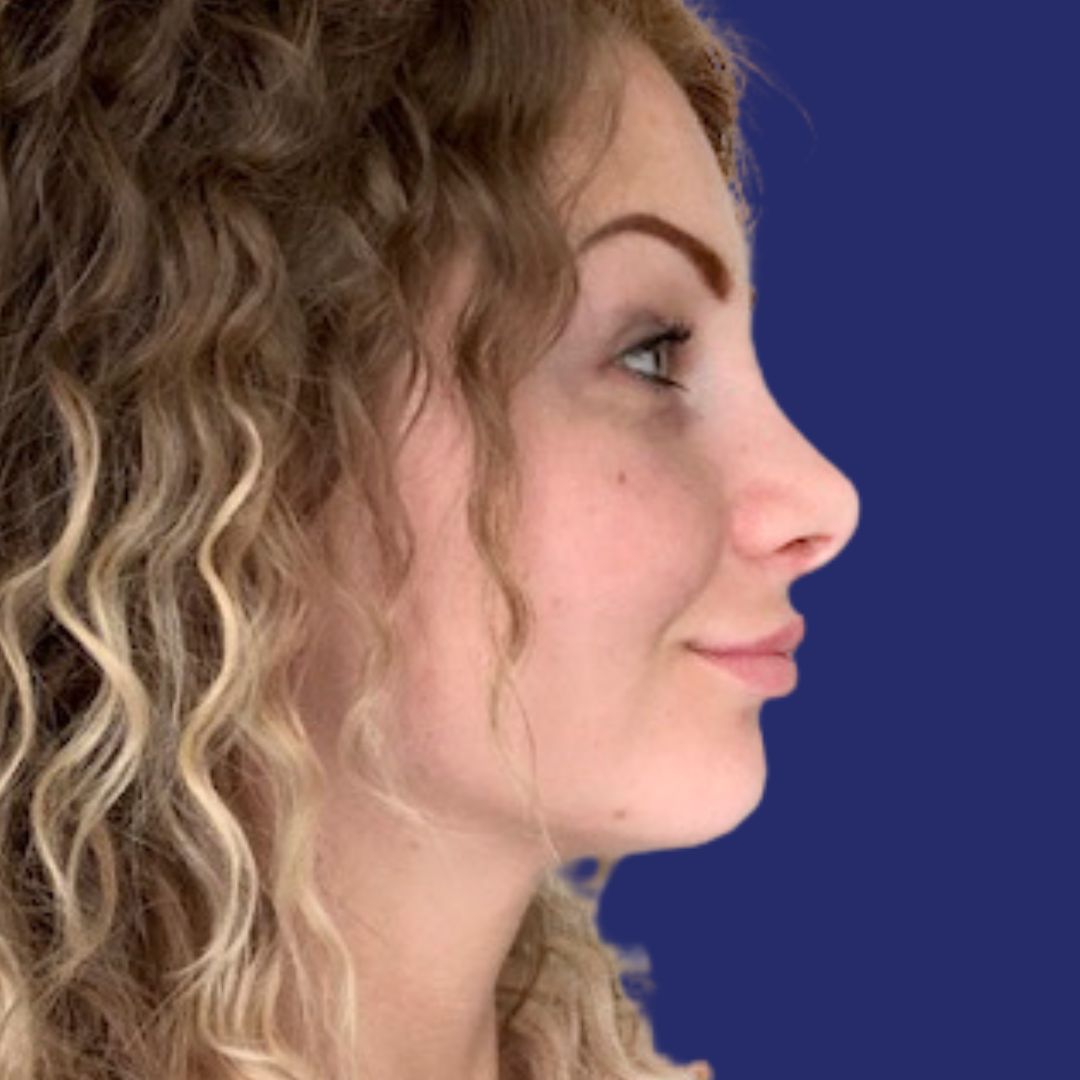 Verfijnde, natuurlijk ogende neus na esthetische neuscorrectie