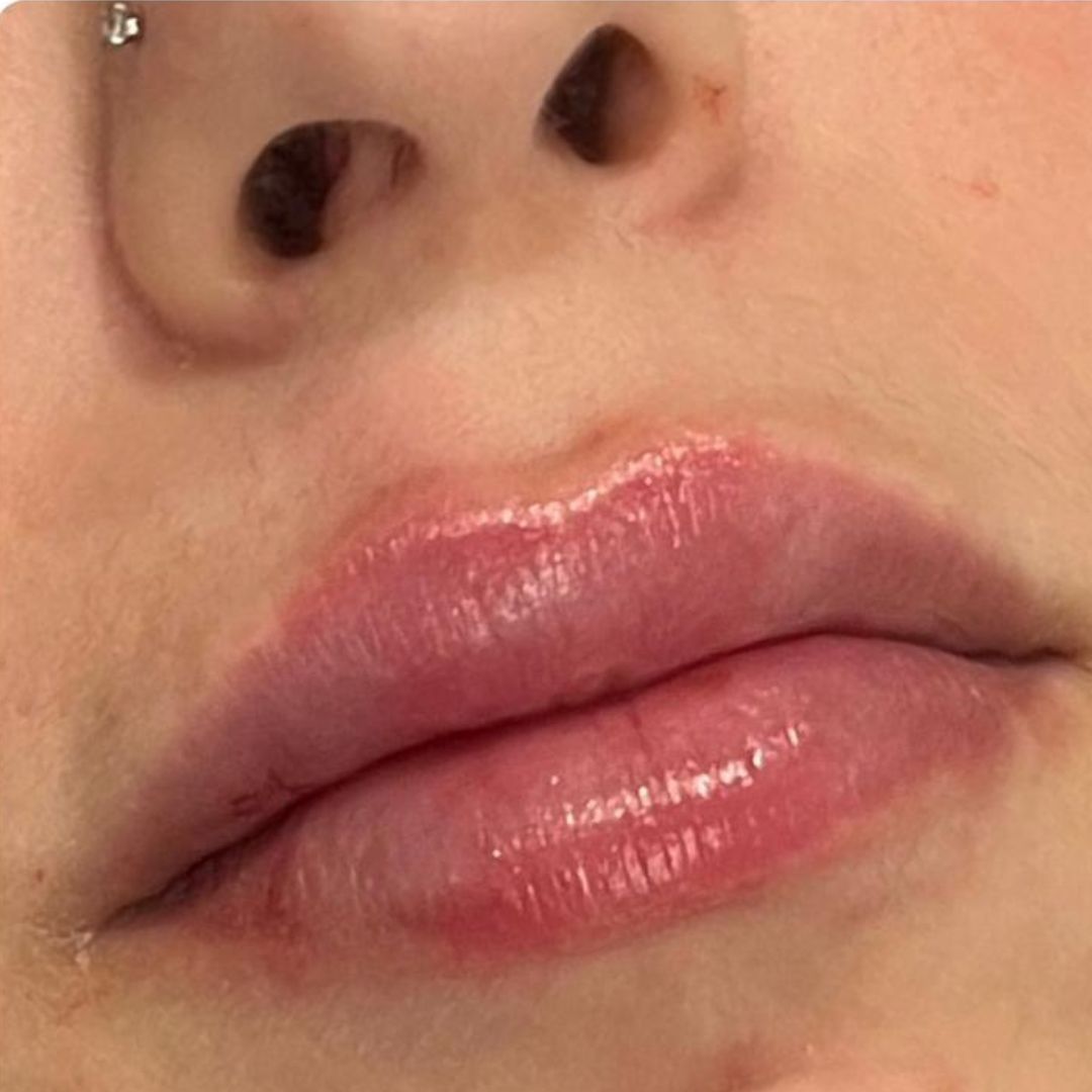 Foto na de behandeling, met voller ogende lippen en strakkere lipcontour.