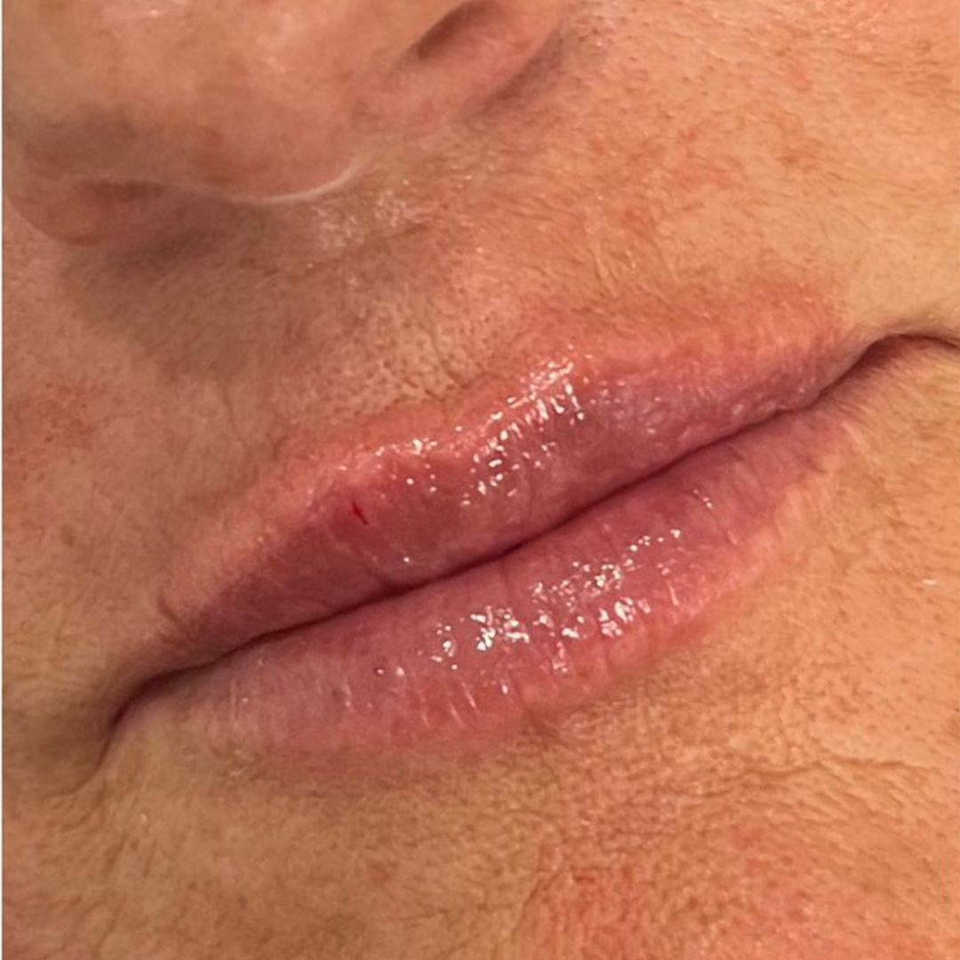Afbeelding na de lipfillerbehandeling, met subtiel verbeterd volume en contour.