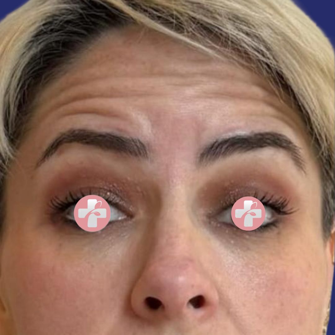 Voorfoto van een patiënte met zichtbare frons- en voorhoofdsrimpels vóór Botoxbehandeling.