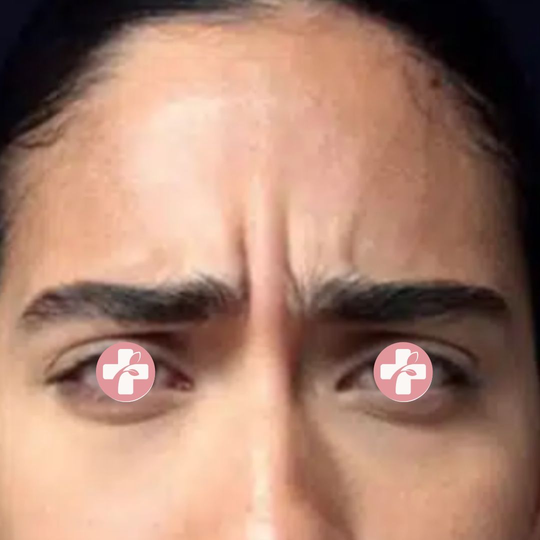 Voorfoto met uitgesproken frontale rimpels vóór behandeling.