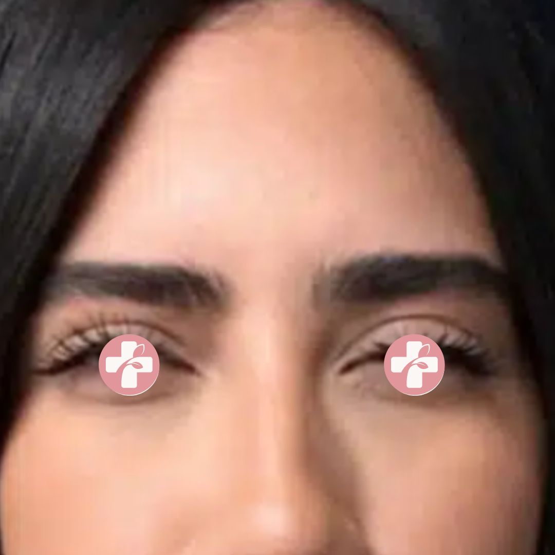 Nafoto na toediening van botulinetoxine met gladdere huidstructuur.