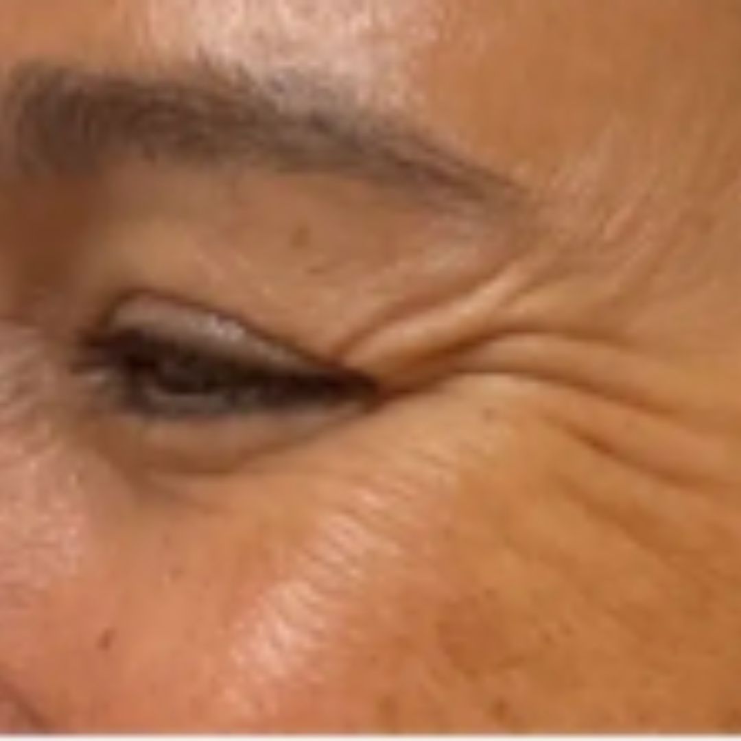 Voorbeeld vóór behandeling met botulinetoxine met zichtbare kraaienpootjes.