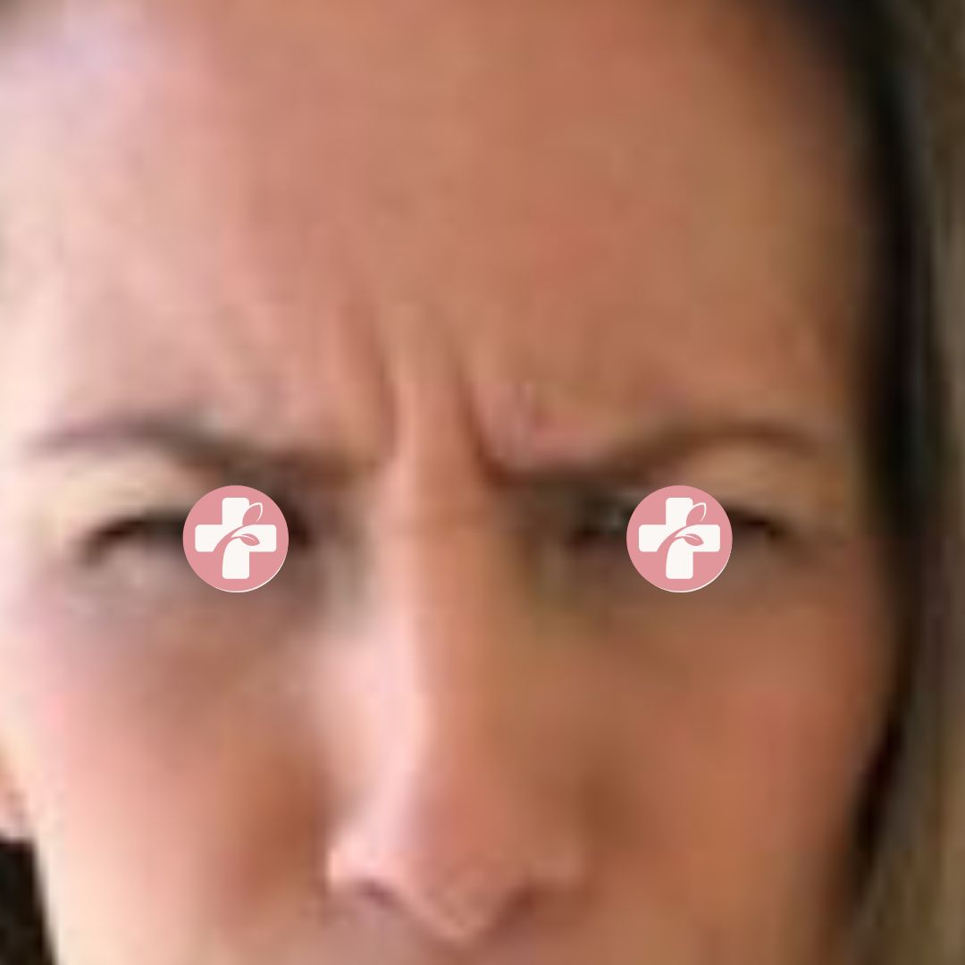 Voorbeeld met horizontale lijnen in het voorhoofd vóór anti-rimpelbehandeling.